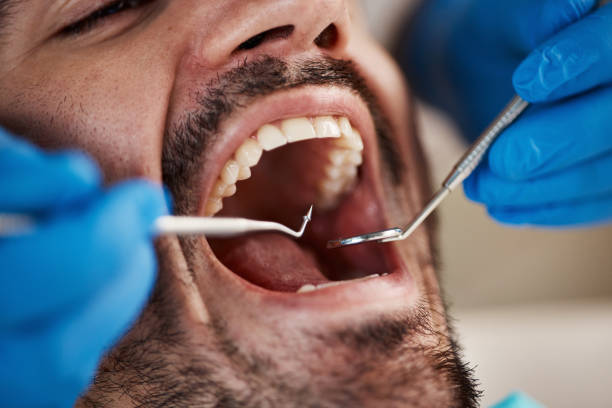 Best Emergency Wisdom Teeth Removal in West Unity, OH